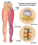 Siyatik Ağrısı Belirtileri ve Tedavisi