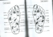 Siyatik Romatizma Belirtileri ve Tedavisi