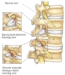 Siyatik Sinir Zedelenmesi Belirtileri ve Tedavisi