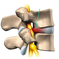 Bel Fıtığı Siyatik Belirtileri ve Tedavisi